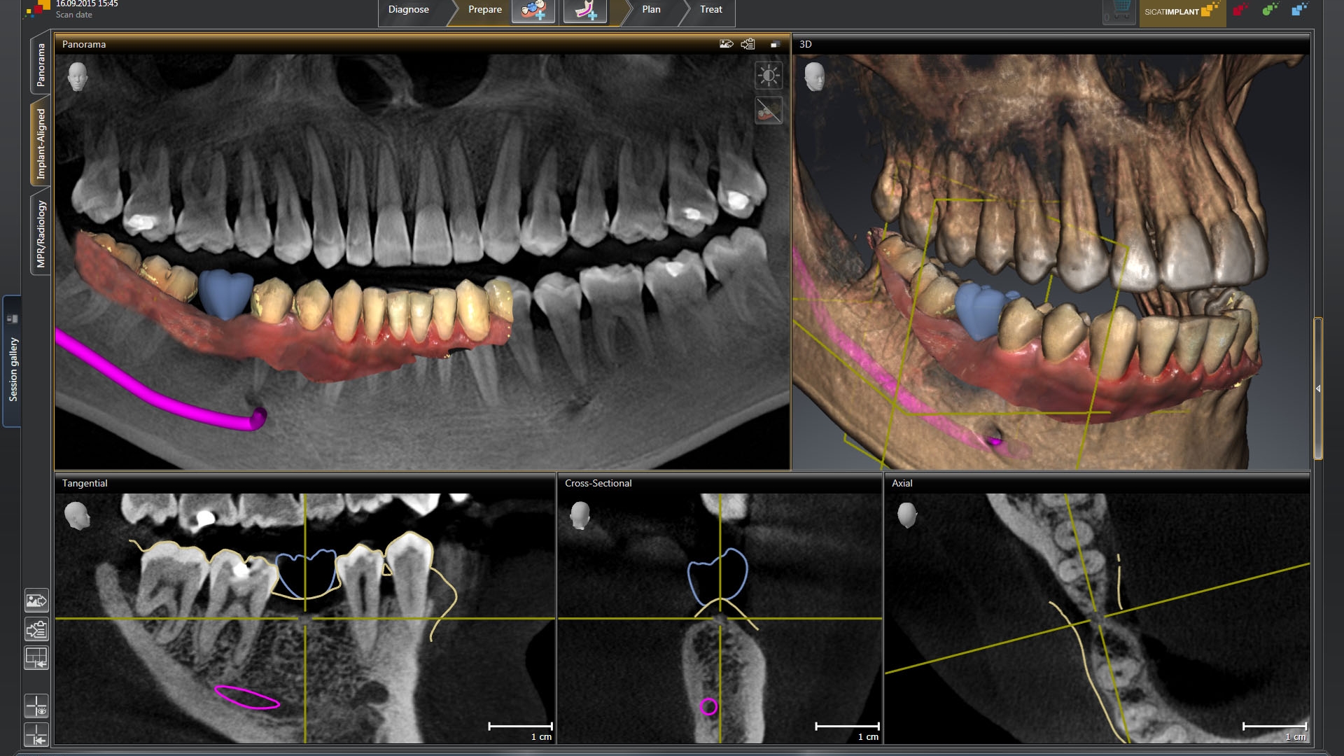 CBCT 3D X-rays; treatment planning