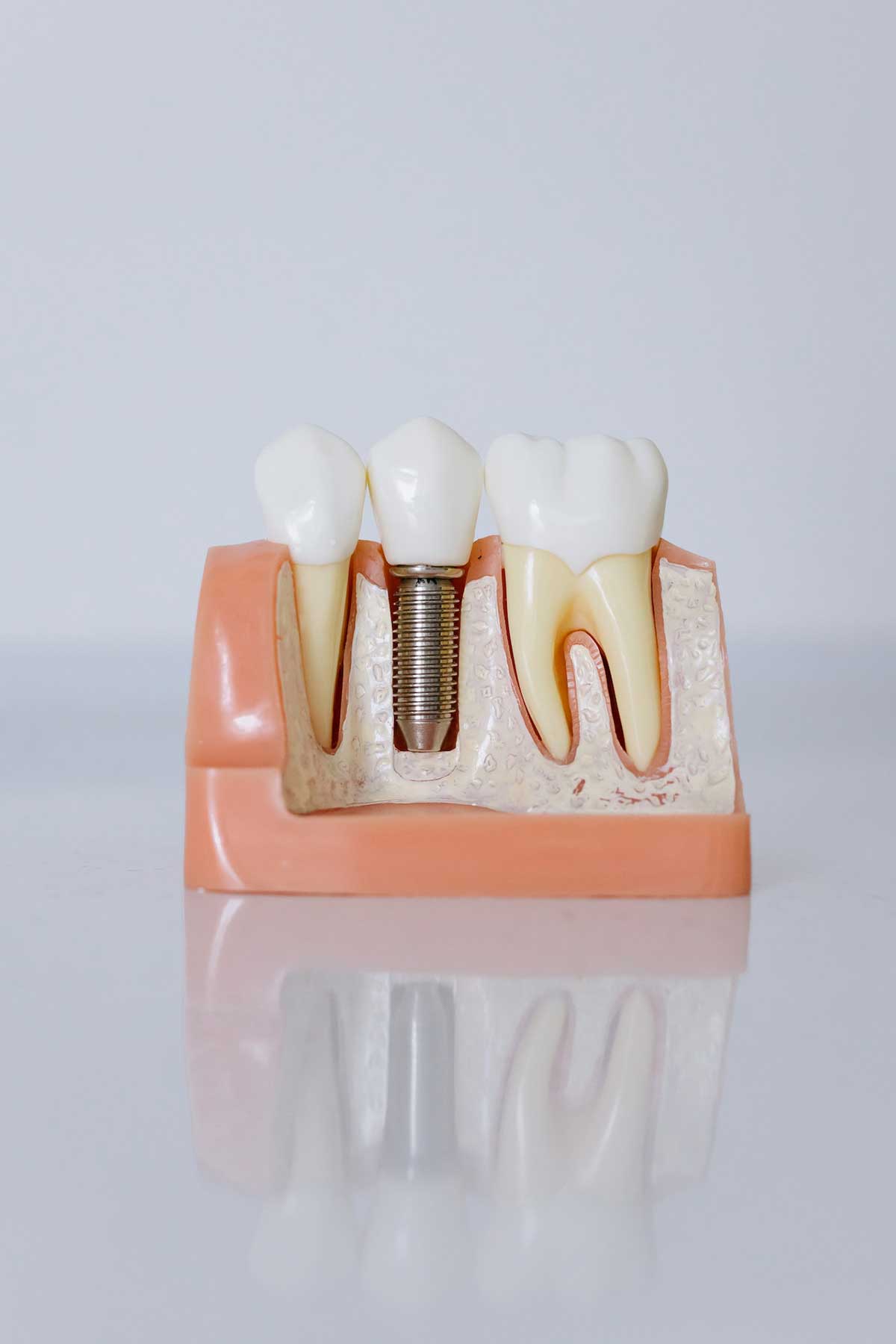 Example of dental implant